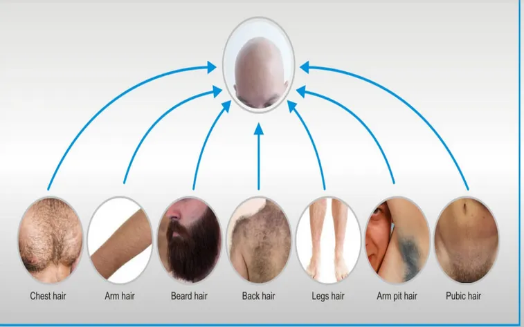 Hair Grafting Process | Hair Restoration: Assure Clinic 