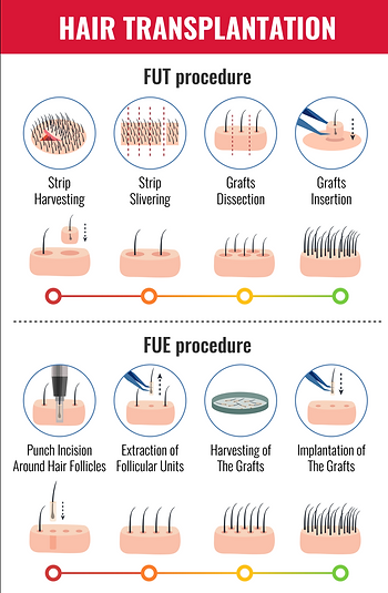 Hair Transplantation | FUE Treatment: Assure Clinic