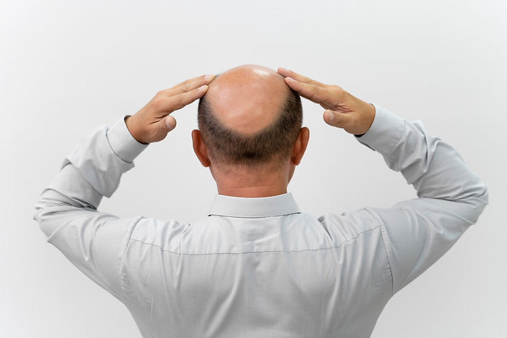 Can I go bald again after a hair transplant?