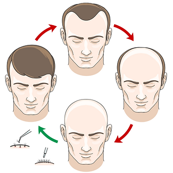 Hair Transplant Procedure | Hair Restoration: Assure Clinic