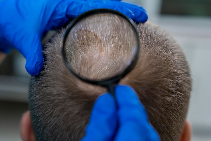 Hair Loss | Hair Restoration Clinic: Assure Clinic
